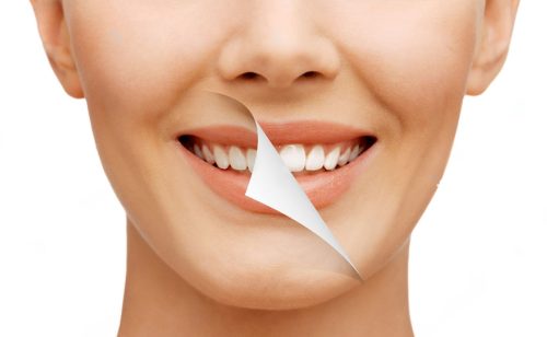 teeth-whitening-01
